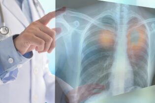 سرطان الرئة